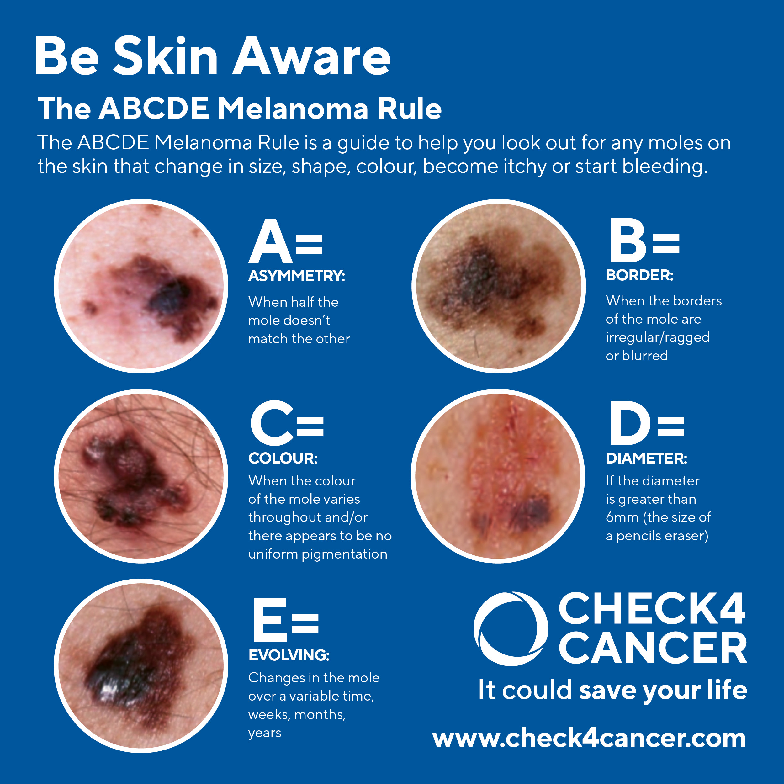 The ABCDE Rule Skin Cancer PNG